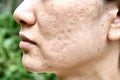 Skin problem with acne diseases, Close up woman face with whitehead pimples, Menstruation breakout. Royalty Free Stock Photo