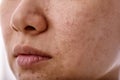 Skin problem with acne diseases, Close up woman face with whitehead pimples on mouth. Royalty Free Stock Photo