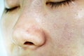 Skin problem with acne diseases, Close up woman wrinkle face with whitehead pimples on nose