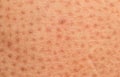 Skin problem,Dry skin ichthyosis vulgaris Royalty Free Stock Photo