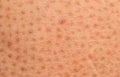 skin problem,Dry skin ichthyosis vulgaris Royalty Free Stock Photo
