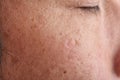 Skin problem with wrinkle and pigmentation, Close up men face with acne and dry skin