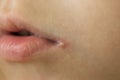 Skin problems, angulitis, angular stomatitis, angular cheilitis  a disease of the mucous membrane and skin Royalty Free Stock Photo