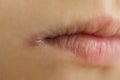 Skin problems, angulitis, angular stomatitis, angular cheilitis  a disease of the mucous membrane Royalty Free Stock Photo