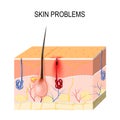 Skin problems. Clogged pores Royalty Free Stock Photo