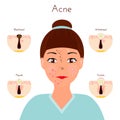 Skin problems. Girl closse up face with different types of acne pimples. Facial treatments and problems vector Royalty Free Stock Photo