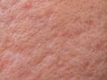Skin problems, nodular cystic acne skin Royalty Free Stock Photo