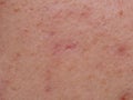 Skin problems, nodular cystic acne skin