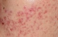 Skin problems, nodular cystic acne skin Royalty Free Stock Photo