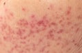 Skin problems, nodular cystic acne skin