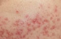 Skin problems, nodular cystic acne skin