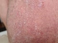 Skin psoriasis on a male leg concept