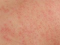 Skin rash