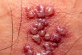 Skin rash and blisters on body. Shingles on men herpes zoster Royalty Free Stock Photo