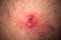 Skin rash and blisters on body. Shingles on men herpes zoster Royalty Free Stock Photo