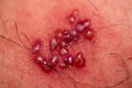 Skin rash and blisters on body. Shingles on men herpes zoster Royalty Free Stock Photo