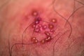 Skin rash and blisters on body. Shingles on men herpes zoster Royalty Free Stock Photo