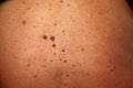 Skin rash skin cancer skin wart Royalty Free Stock Photo