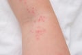 Skin rash on female arm, itchy pimples as a result of an allergic reaction, response, concept of allergy and dermatology Royalty Free Stock Photo