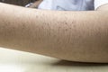 Skin rash in a patient diagnosed with chikungunya disease