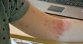 Skin rash,alergy