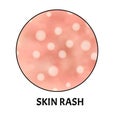 Skin rash. Symptom of dermatitis, allergies, psoriasis, eczema. Icons skin rash. Acne Infographics. Vector illustration