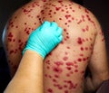 skin rash treatment on male body. Shingles, Disease, Herpes zoster, varicella-zoster virus