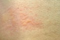 Skin rash, Urticaria, Allergic skin reaction. Royalty Free Stock Photo