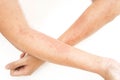 Skin rashes, allergies contact dermatitis , allergic to chemicals