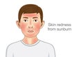 Skin redness appear on facial and neck of kid from sunburn. Royalty Free Stock Photo