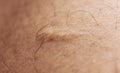 Skin scarring, traces of past accidents macro photos spot blur Royalty Free Stock Photo