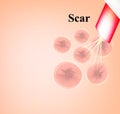 Skin scars after acne and pimples. Treatment of scars on the skin of the face with a laser. Infographics. Vector