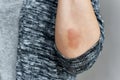 Skin scratch allergy diseases problem, Close up of atopic dermatitis rash, Female dermatology patient with allergic eczema on arm. Royalty Free Stock Photo