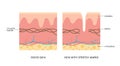 Skin with and without stretch marks