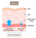 Diagram of edema illustration. Skin swelling is caused by excess fluid within the tissues of the body. Health care concept