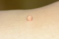 Skin tag or acrochondon or soft fibroma