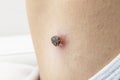 Skin tag mole darkened, scorched and dried up