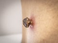 Skin tag mole darkened, scorched and dried up