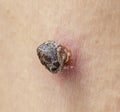 Skin tag mole darkened, scorched and dried up