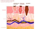 Skin tumors, moles and spots, 3d section of the skin layer