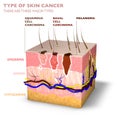 Skin tumors, moles and spots, 3d section of the skin layer