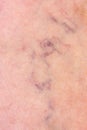 Skin with varicose veins Royalty Free Stock Photo