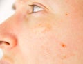 Skin of woman with blemish and spots