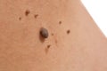 Skin of a woman with moles