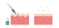 Skin with wrinkles and fine line before and after injection