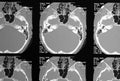 Magnetic resonance skull base mri