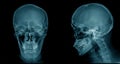 Skull x-ray image, head injury x-ray