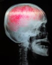 Skull X-Ray on pateint coronavirus or covid-19