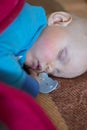 Sleeping baby with manifestations of an allergy on the face Royalty Free Stock Photo