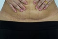 Slim and fit figure after the longitudinal caesarean section. Scar after a Caesarean section, Bikini line. Closeup of a scar on t